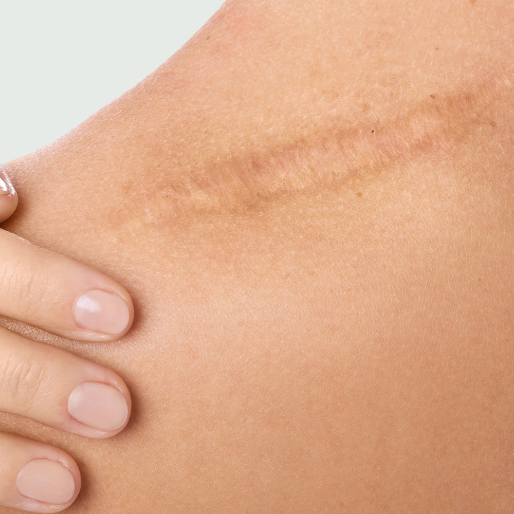 Scar Removal